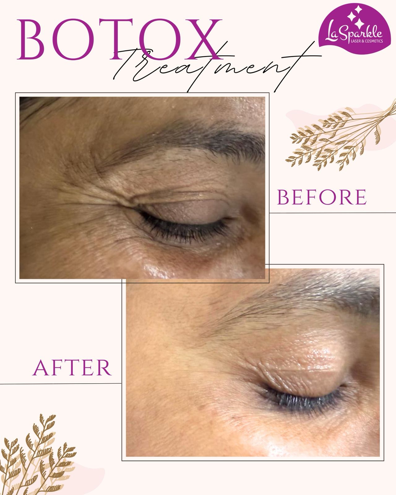 Acne treatment before and after cheek skin clearance