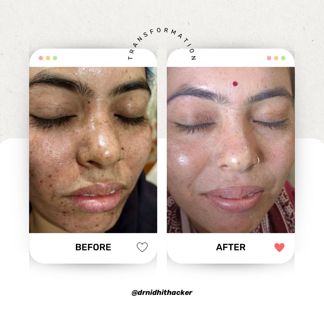 Laser hair reduction results on lower face jawline