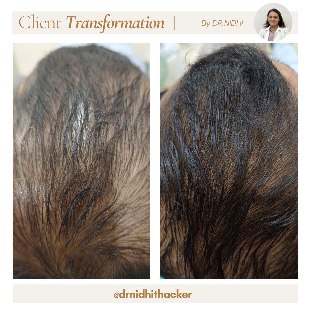 Freckles and age spot reduction with laser therapy before and after