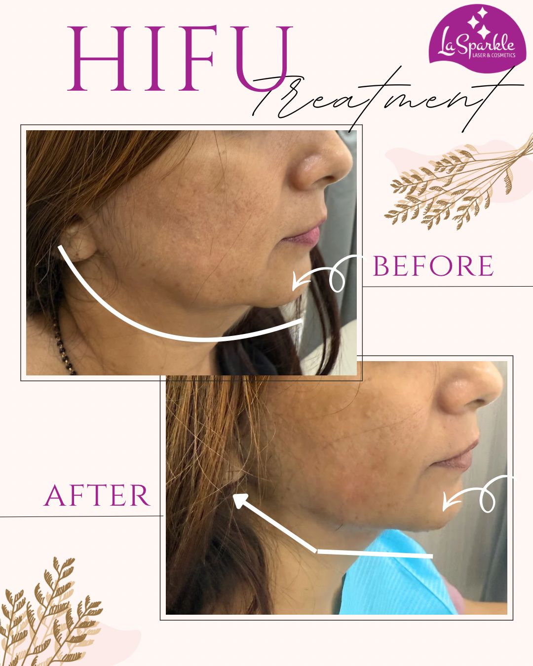 Even skin tone and hyperpigmentation reduction results