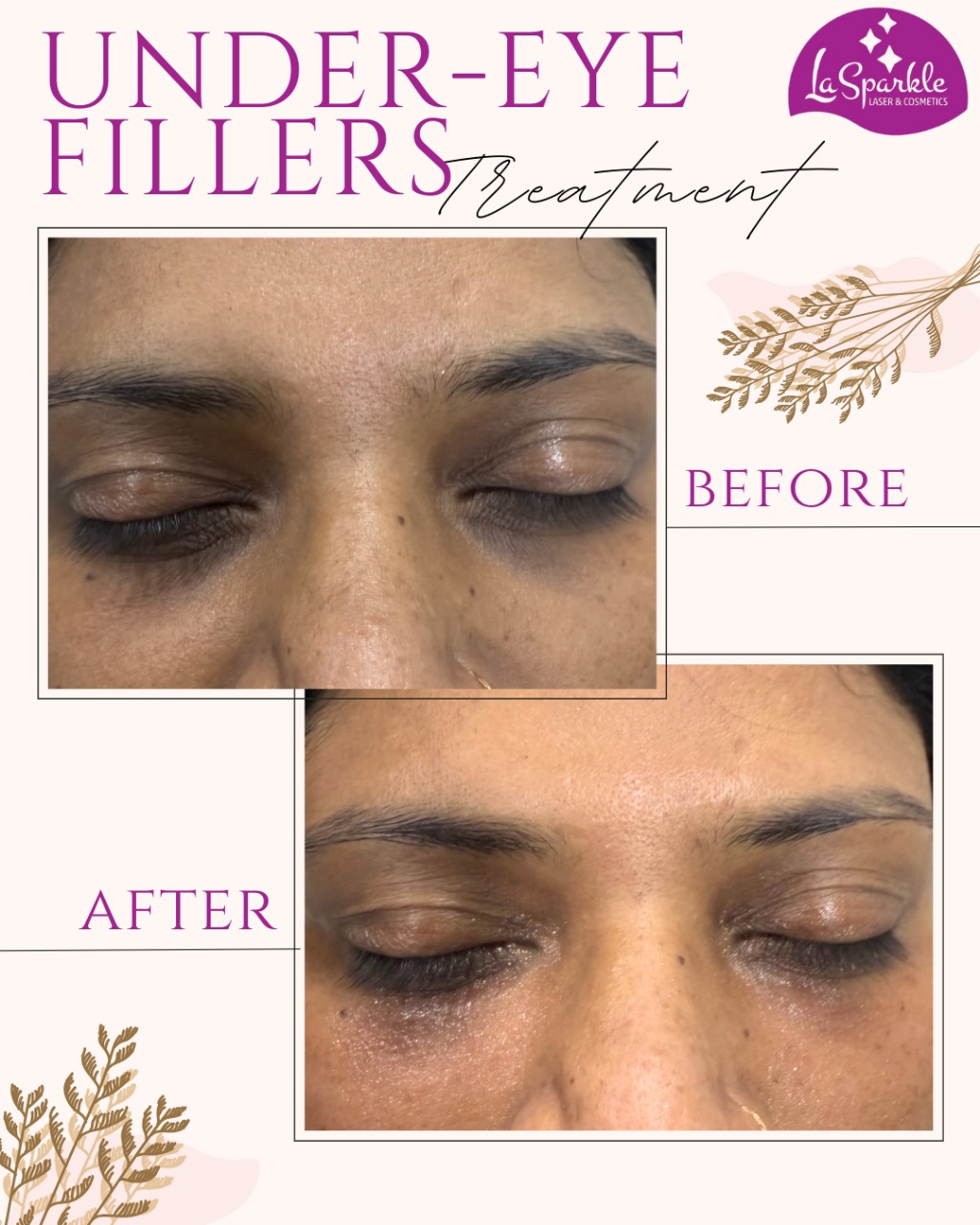 Laser hair reduction machine and protective treatment setup